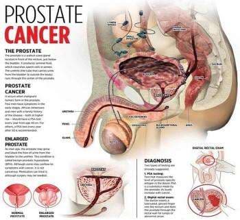 Prostate Cancer Treatment: Effective Medicine & Supplements in Accra, Ghana