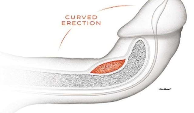 Curved Penis (Penile Curvature) Natural Treatment: Creams & Medicine in Accra, Ghana