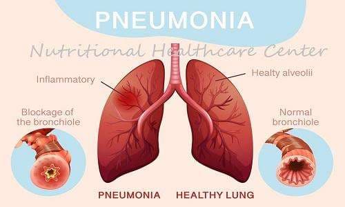 Pneumonia Treatment Medicine, Ghana