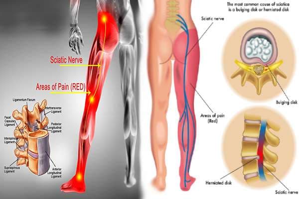 Nerve Pain Treatment: Effective Medicine & Remedies in Accra, Ghana