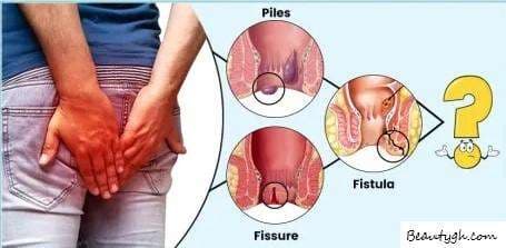 Piles (Kooko) Treatment: Effective Medicine & Remedies in Accra, Ghana